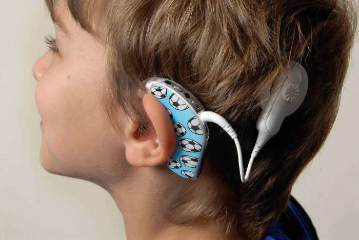 Which of the following statements about cochlear implants is false